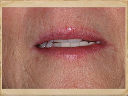 Implants Dentist in Livingston