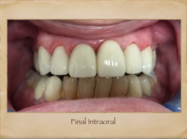 Implants Dentist in Livingston