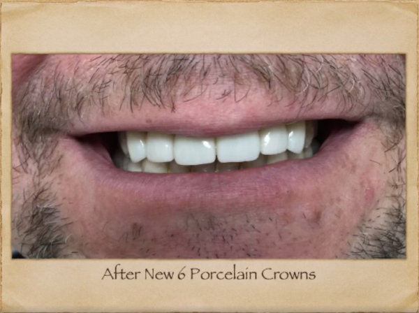 Implants Dentist in Livingston