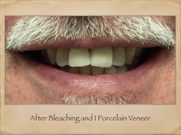 Implants Dentist in Livingston