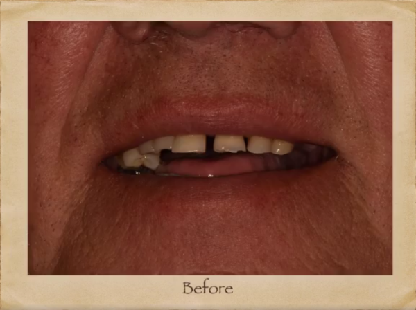 Implants Dentist in Livingston