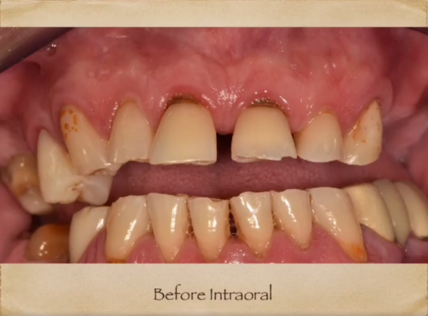 Implants Dentist in Livingston