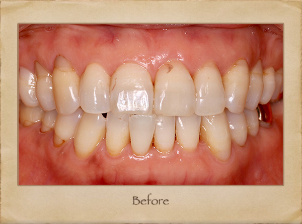 Implants Dentist in Livingston