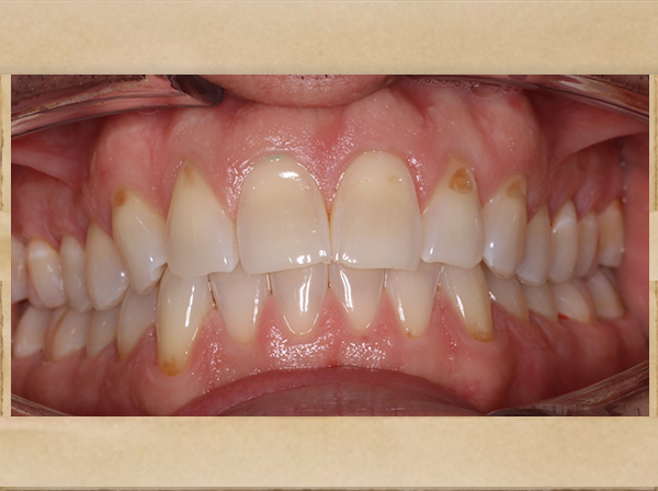 Living Smiles Dentistry | Dentures, Preventative Program and Dental Cleanings