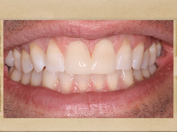 Living Smiles Dentistry | Dental Bridges, Dental Fillings and All-on-4 reg 