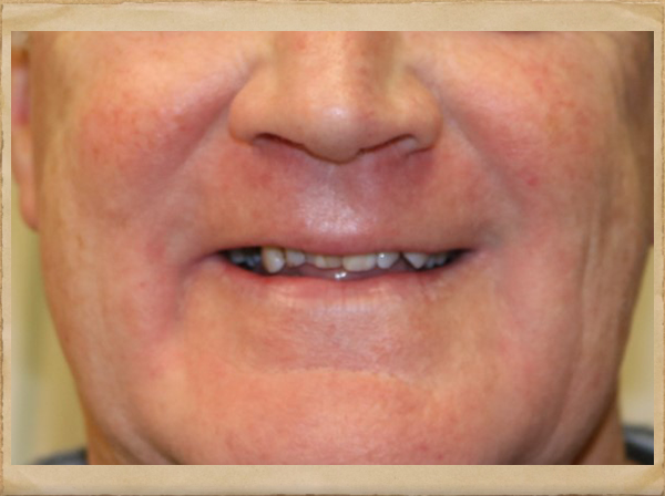 Living Smiles Dentistry | Air Abrasion, All-on-4 reg  and Botox reg 