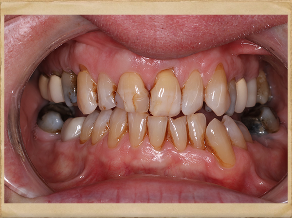 Living Smiles Dentistry | ClearCorrect reg , Ceramic Crowns and Extractions