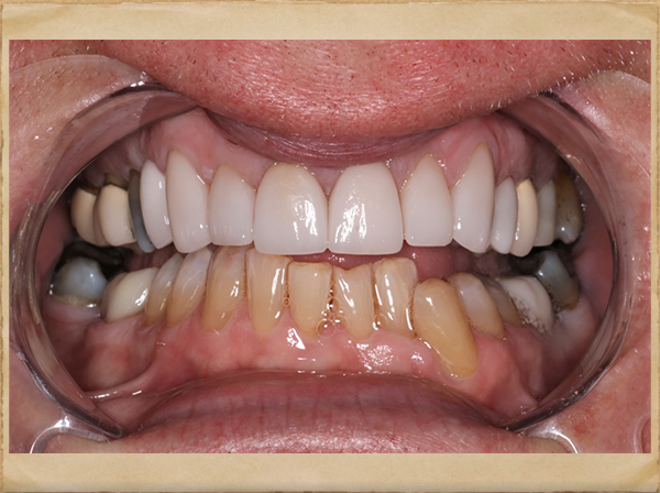 Living Smiles Dentistry | Emergency Treatment, Veneers and Invisalign reg 