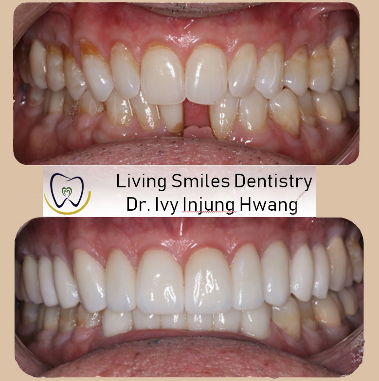 Livingston NJ Teeth Whitening | Invisalign in Livingston ...